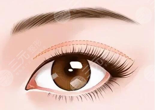 武汉天佑医院双眼皮项目介绍