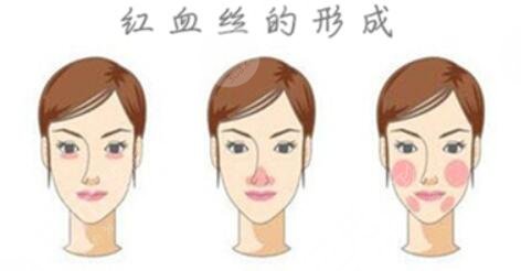 脸上为什么会出现红血丝?