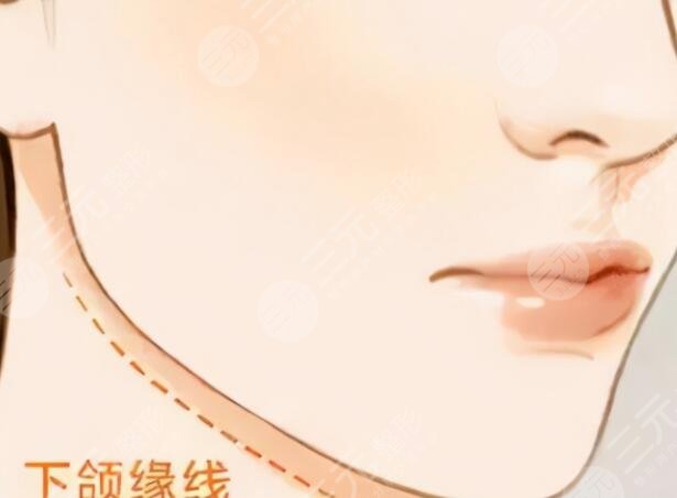 下颌角长曲线截骨术价格的影响因素有哪些?