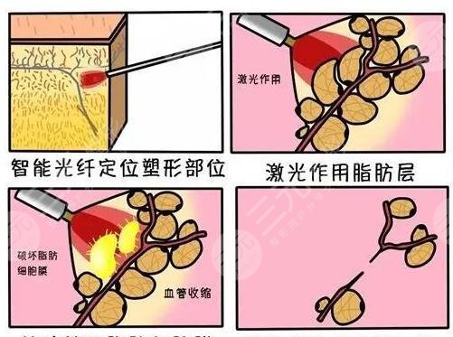 等离子激光溶脂果如何？