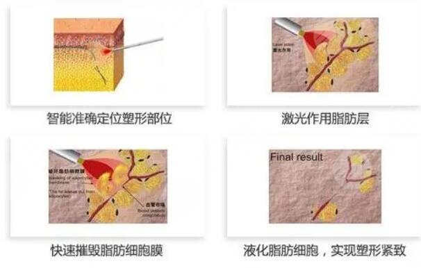 等离子激光溶脂三大功能有哪些?