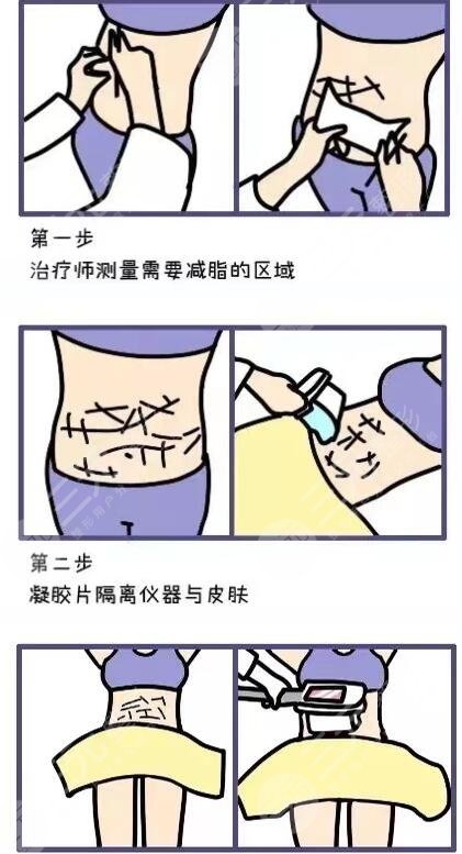 等离子激光溶脂手术前要注意什么?