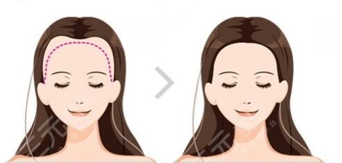 植发手术是怎么收费的？植发究竟要准备多少钱？告诉你真相！