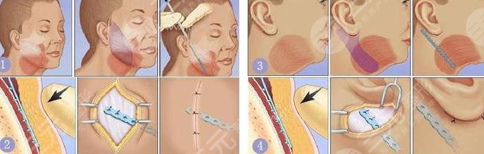 大拉皮除皱手术后可维持多少年