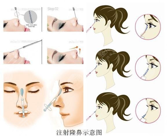 玻尿酸隆鼻可以维持多久?