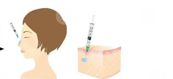 玻尿酸隆鼻可以维持多久?