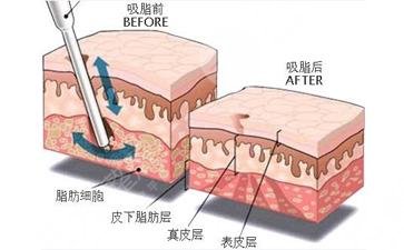 吸脂减肥会反弹吗?