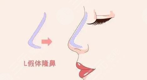 鼻子整形前后对比图