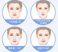 下颌角整形费用高吗？价格表参考！轮廓塑造必看功课~
