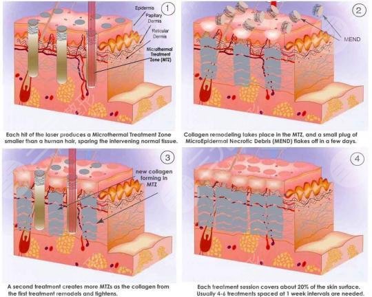 像素激光祛痘坑?果怎么样?