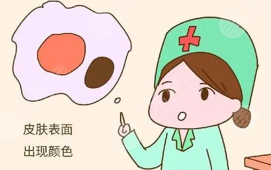 苏州祛胎记多少钱啊?