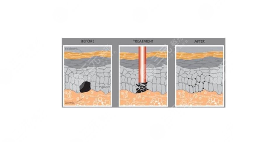苏州祛胎记多少钱啊?