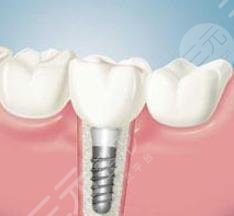 烤瓷牙价格表2023更新