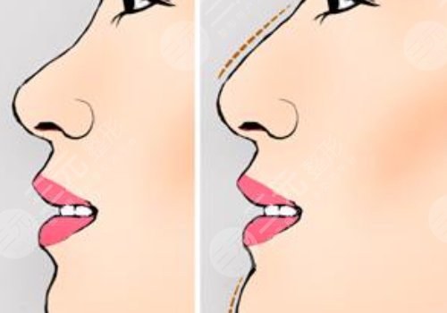 重庆华美做鼻子怎么样？