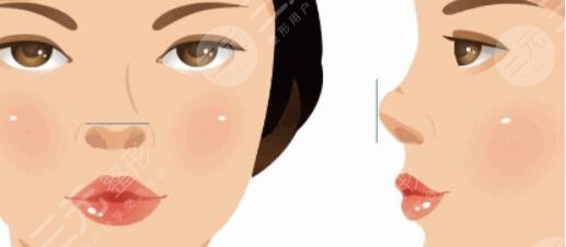 鹰钩鼻整容整形手术后需要注意什么?