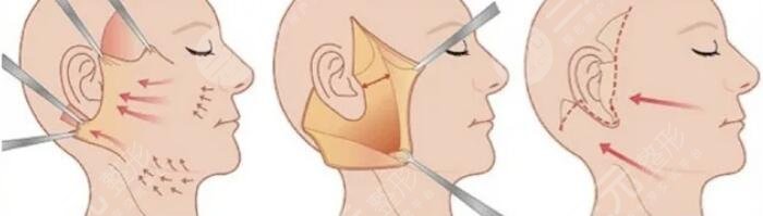 小切口拉皮除皱术需要注意什么呢?