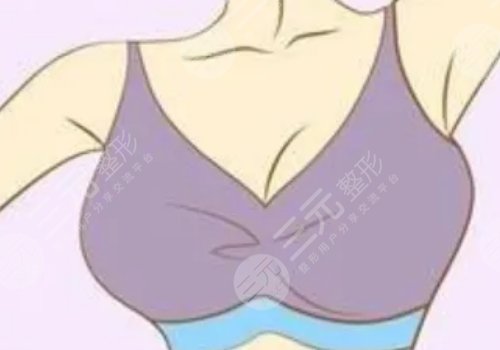 假体隆胸术有哪些特点?
