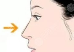 玻尿酸隆鼻恢复时间需要多久？多长时间定型？