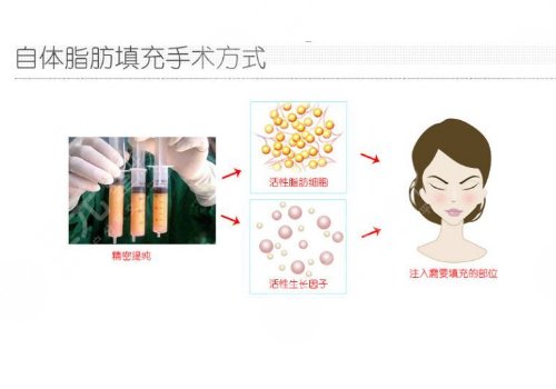 自体脂肪填充下眼睑凹陷可以维持多久?
