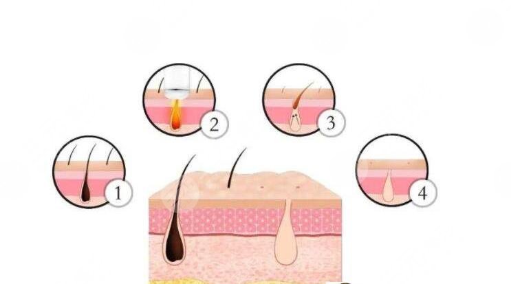 shr冰点脱毛价格是多少?