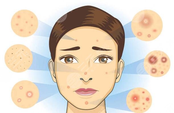 缓解痤疮后需要注意什么?