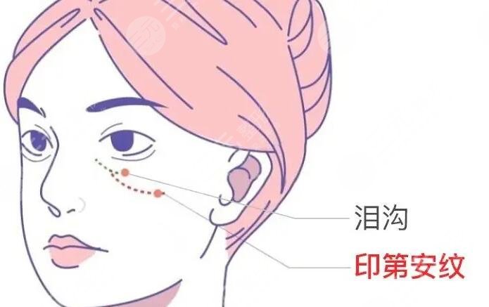 自体脂肪填充泪沟能保持几年时间？