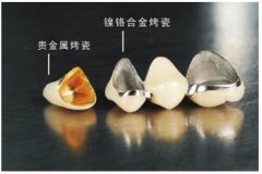 烤瓷牙的危害有哪些？科普解答，这5点不容忽视，牙齿修复必看！