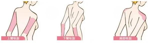 手臂吸脂的恢复期长吗?