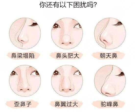 自体软骨隆鼻好吗?