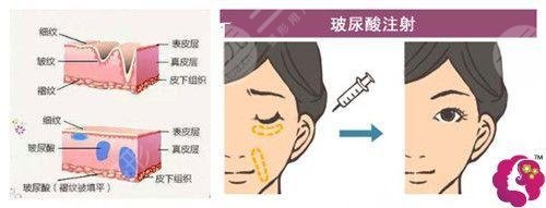 玻尿酸去法令纹需?要多少钱?