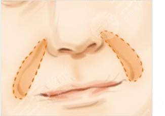 玻尿酸去法令纹需?要多少钱?