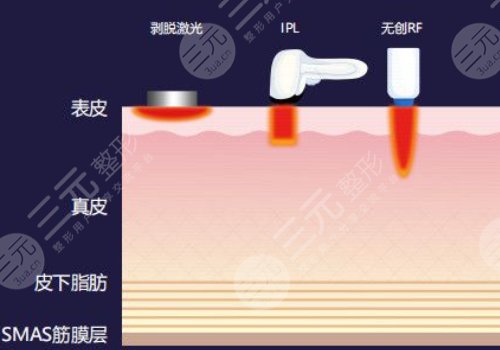 热玛吉和超声炮一起做好还是分开做好