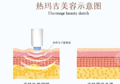 热玛吉和超声炮一起做好还是分开做好