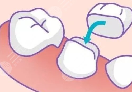 烤瓷牙价格不一样有什么区别?
