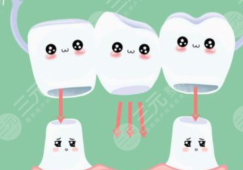 烤瓷牙多少钱一个?