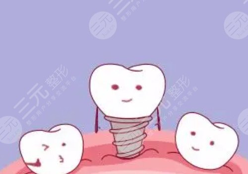 烤瓷牙多少钱一个?