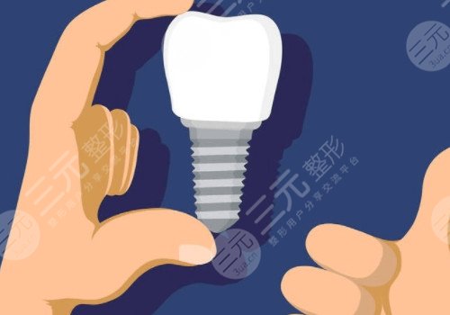 烤瓷牙多少钱一个?