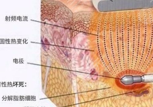 镭射溶脂的危害有哪些？