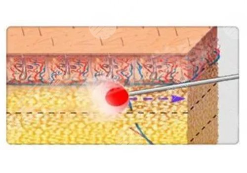 镭射溶脂的危害有哪些？