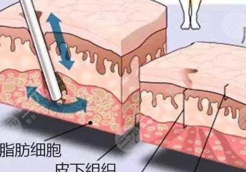 镭射溶脂的危害有哪些？