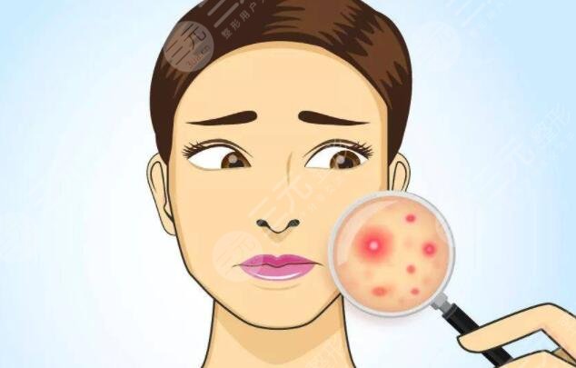 光动力激光缓解痤疮多少钱?