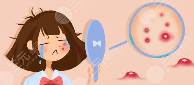 光动力激光缓解痤疮多少钱?