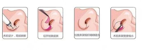 隆鼻手术的技术是什么原理?