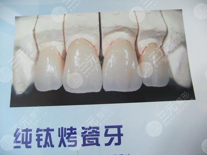 纯钛烤瓷牙价格