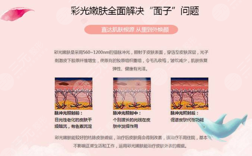 彩光嫩肤好吗?要做?几次?