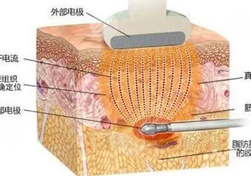 镭射溶脂有效果吗?