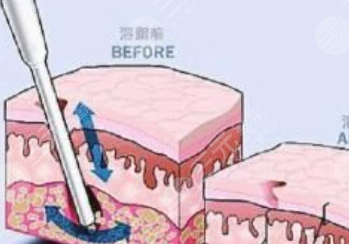 做了镭射溶脂之后需要注意什么?