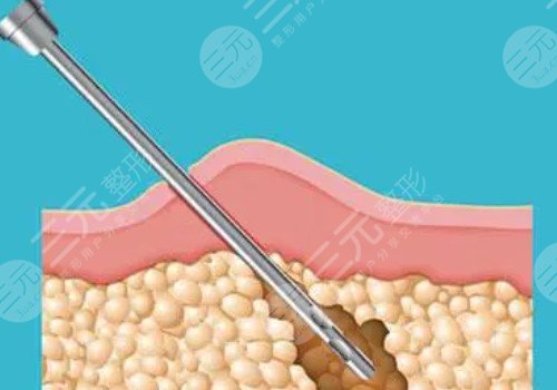 做了镭射溶脂之后需要注意什么?