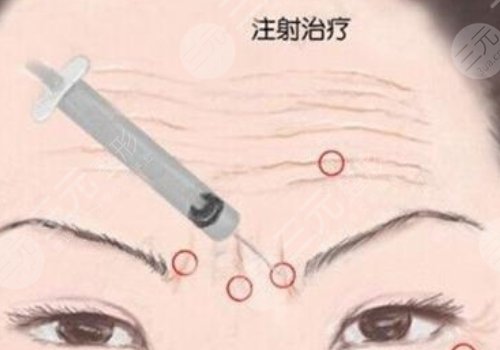 瑞兰2号玻尿酸多少钱?