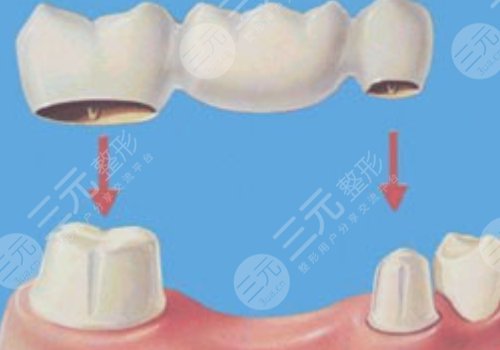门牙烤瓷牙多少钱一颗牙齿?